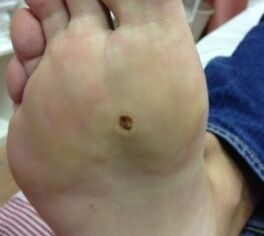 Façons de retirer la verrue sur la semelle des jambes