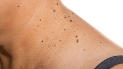 Comment se débarrasser de la papillome autour du cou