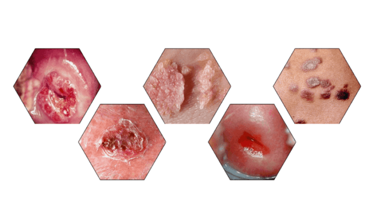 Pourquoi les papillomes sont-ils dangereux