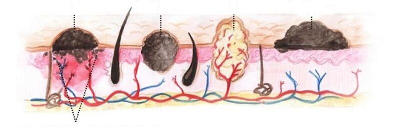 types de papillomes sur le corps humain