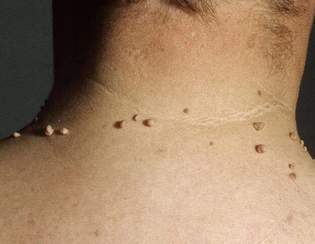 Papillomes sur le cou d'un homme