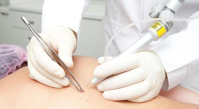 élimination au laser du papillome pour le papillomavirus
