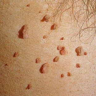 Les papillomes se développent souvent en colonies et peuvent apparaître sur la peau de tout le corps. 